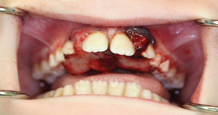 Scurvey was the curse of an 18th century sailor's life. Tooth loss was exceptionally common.